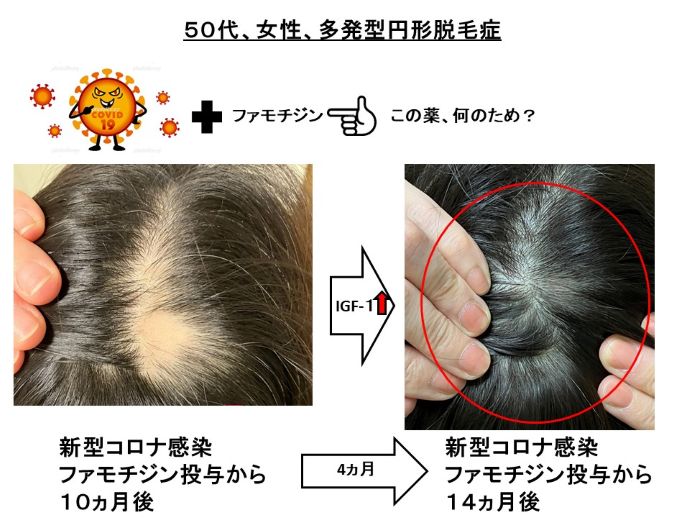 円形脱毛症　病院